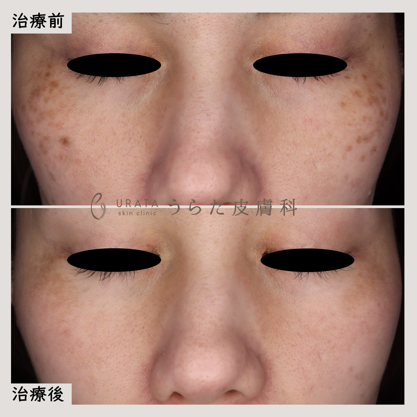 ADMのピコレーザー治療２