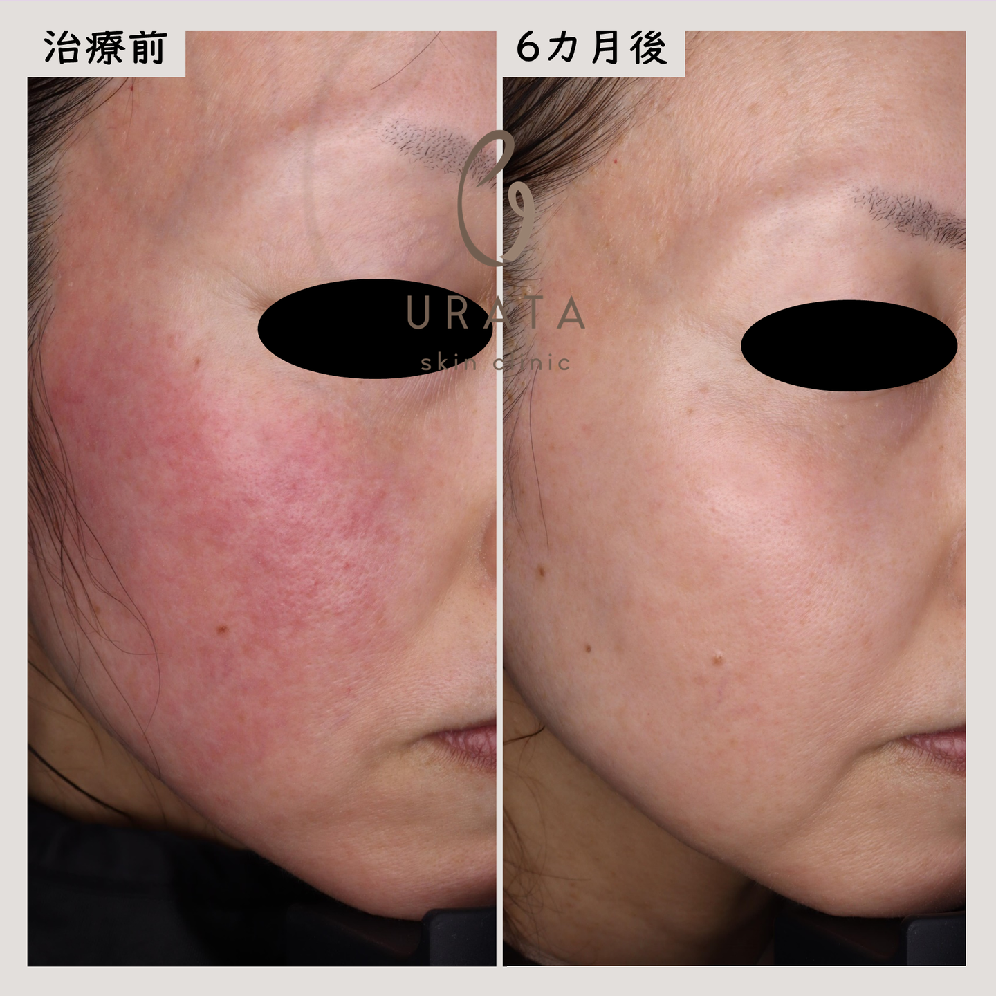 酒さのレーザー治療６