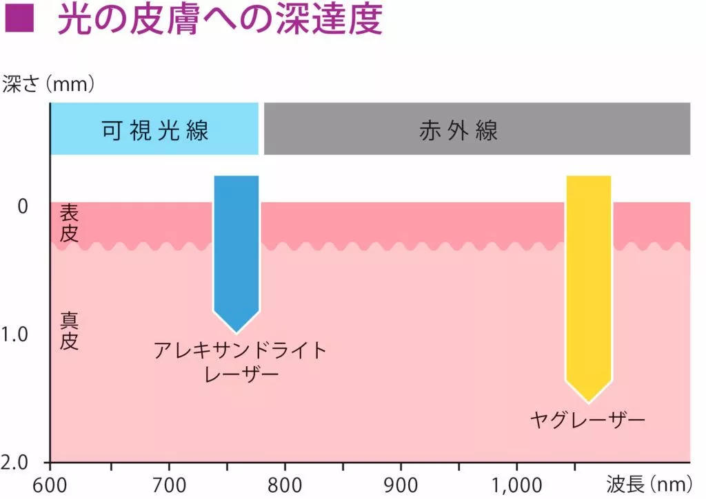 ジェントルマックスプロプラスの光の皮膚への深達度