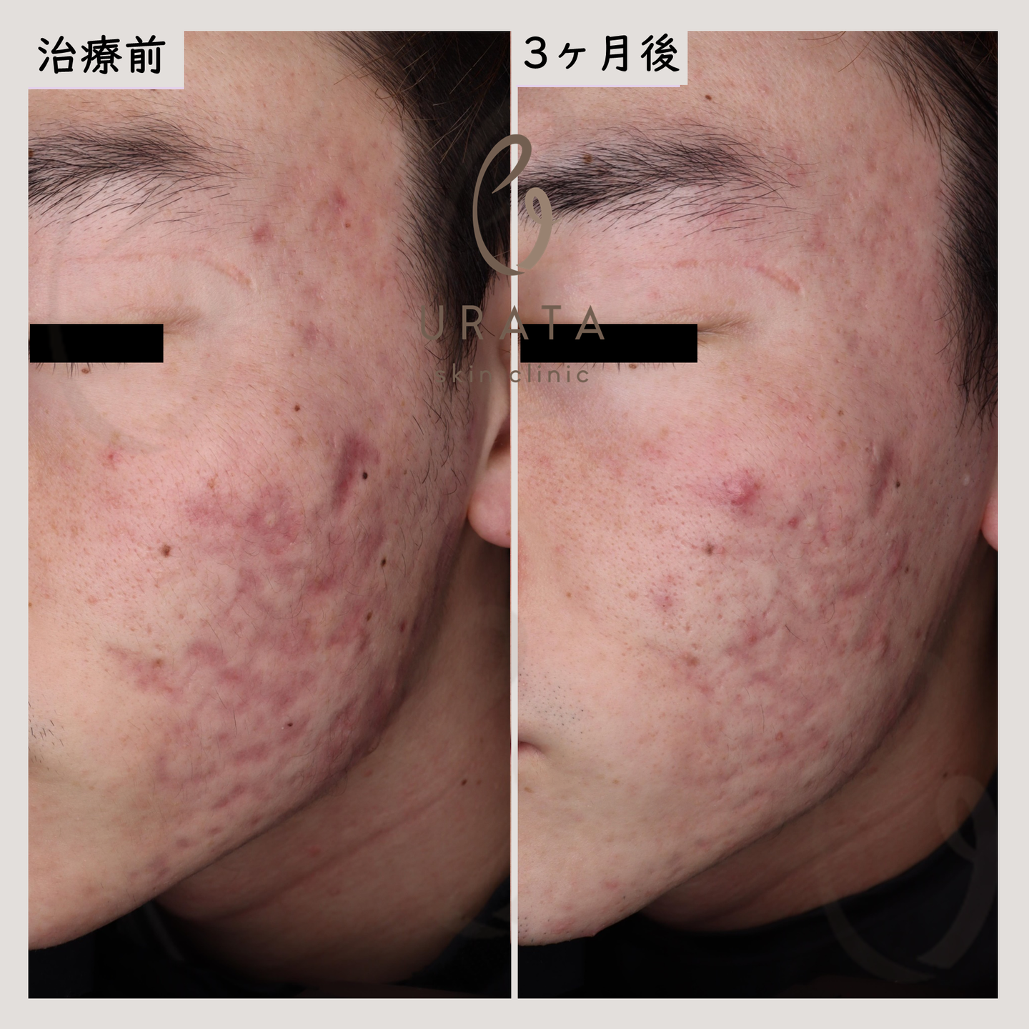 Vビームの赤いニキビ跡治療