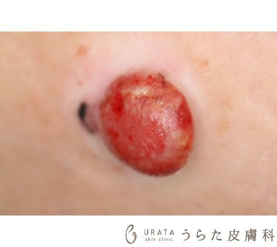 赤い悪性黒色腫