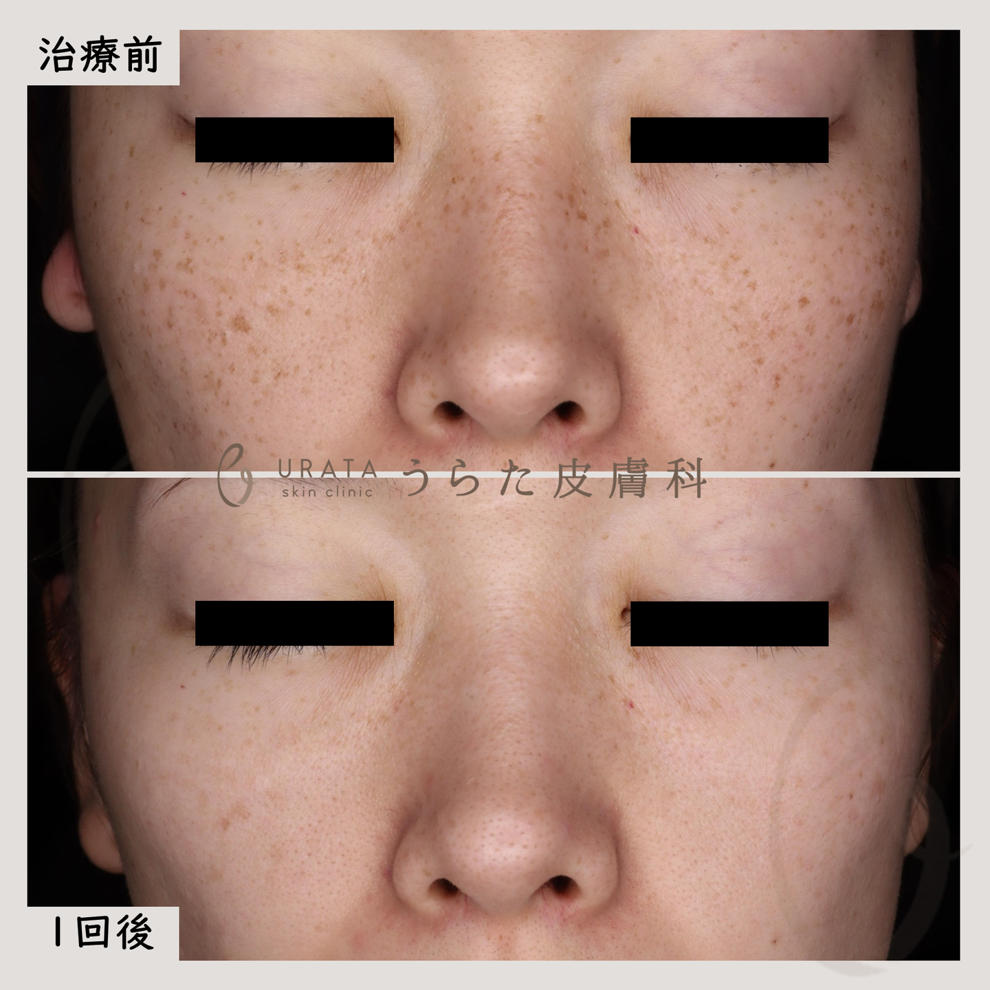 ルメッカのソバカス治療1