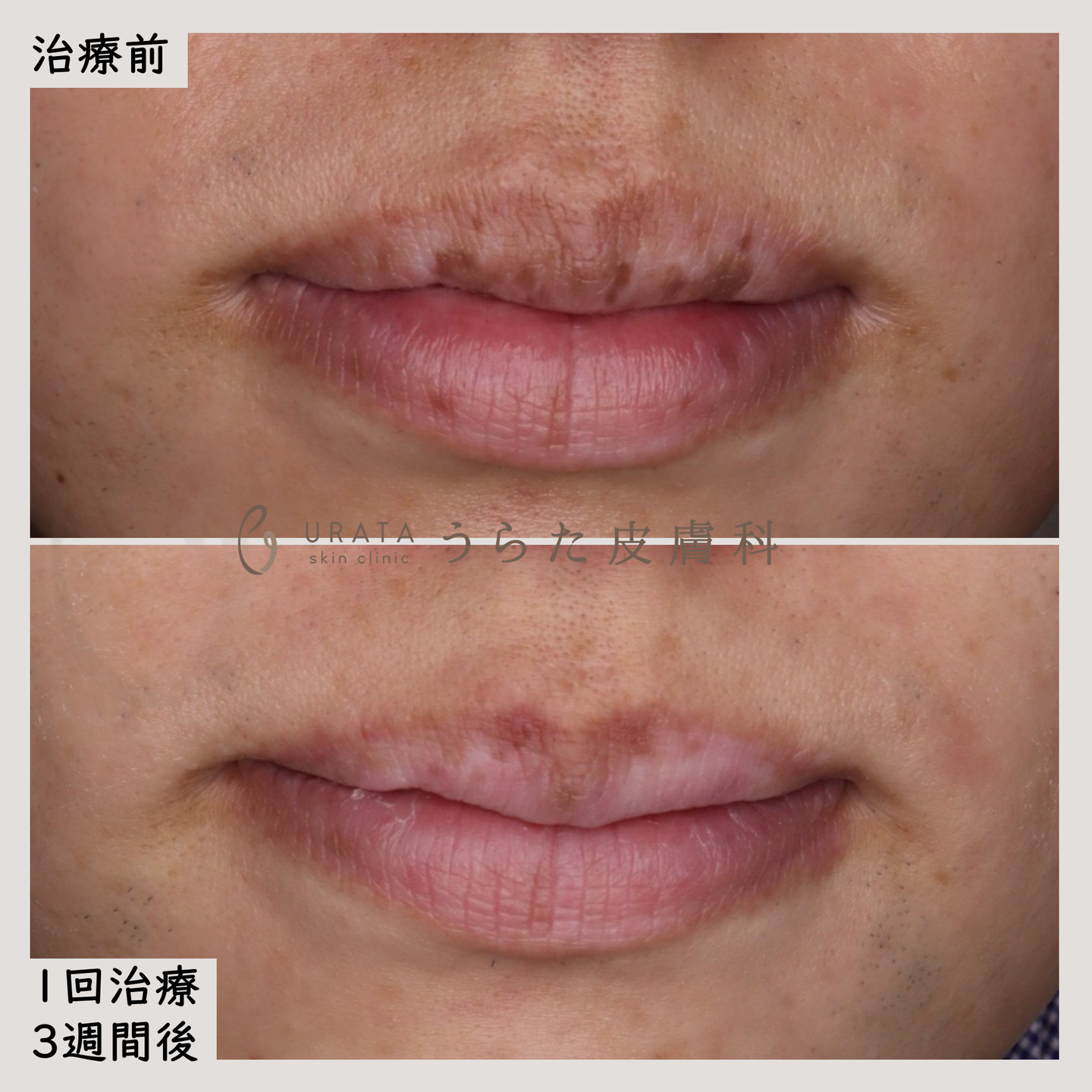 口唇メラノーシスのピコレーザー治療３