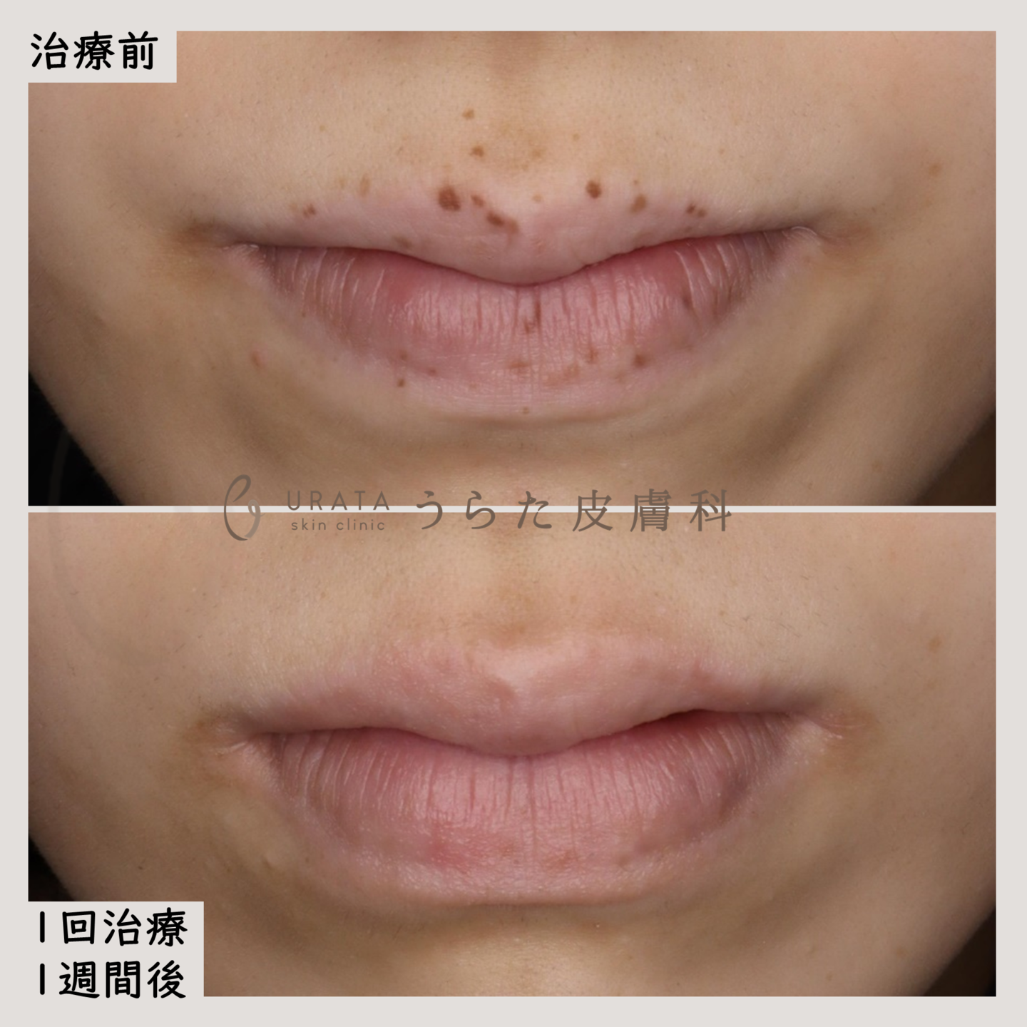 口唇メラノーシスのピコレーザー治療４