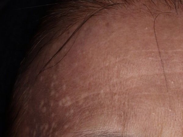 炎症後色素沈着