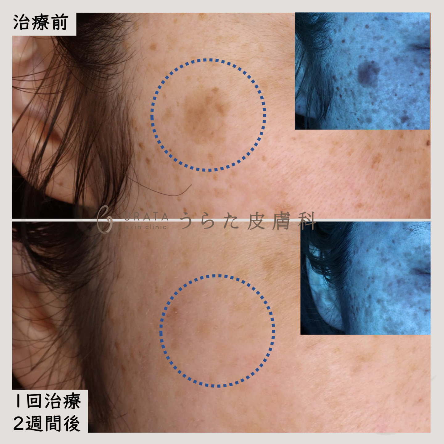 シミのピコスポット治療