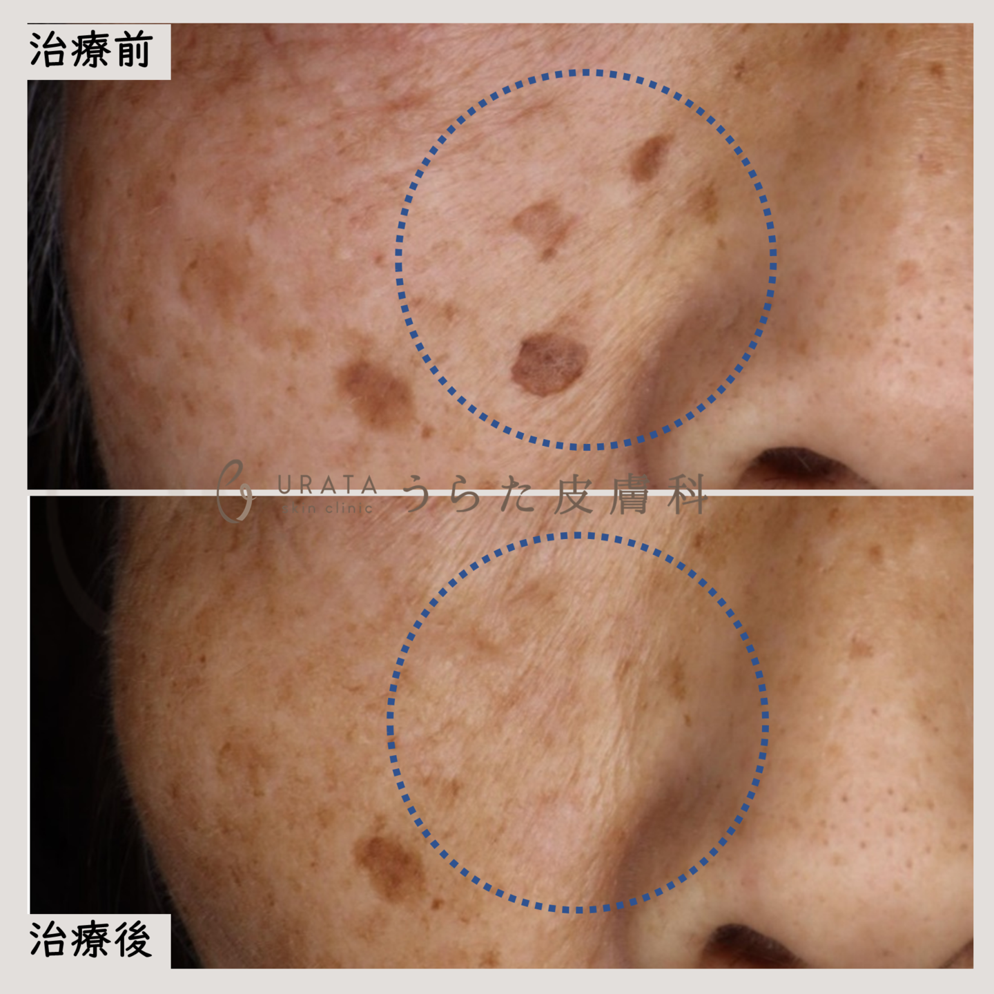 シミのトレチノイン治療