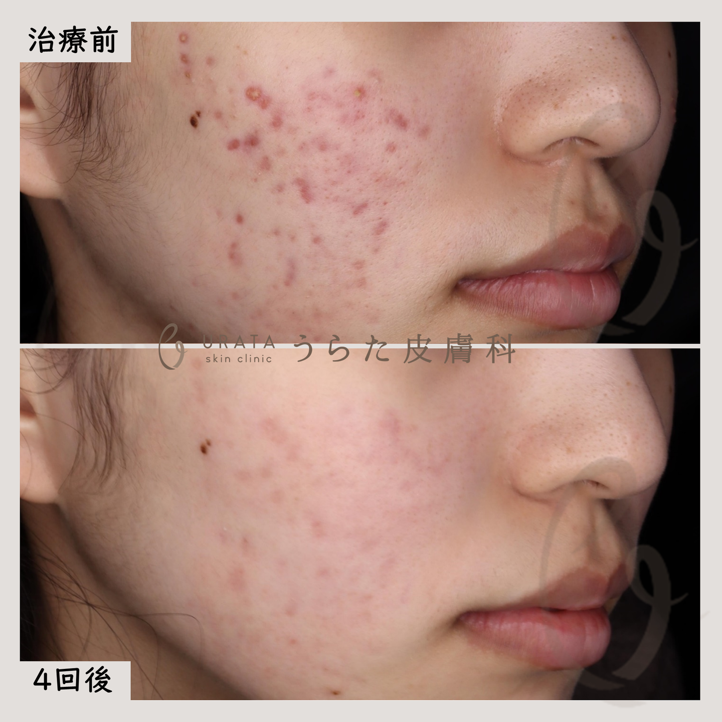 CO2フラクショナルによるニキビ跡治療４