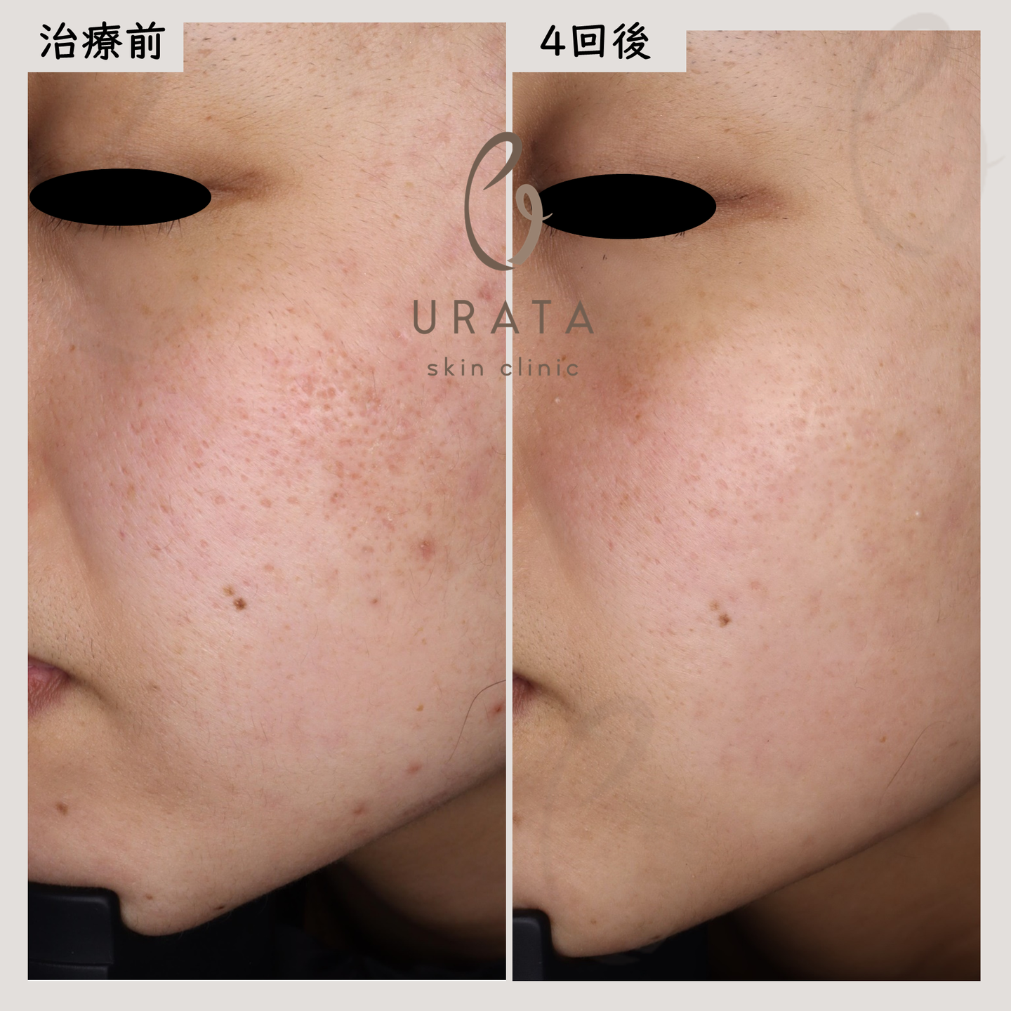 ニキビ跡のポテンツァ治療