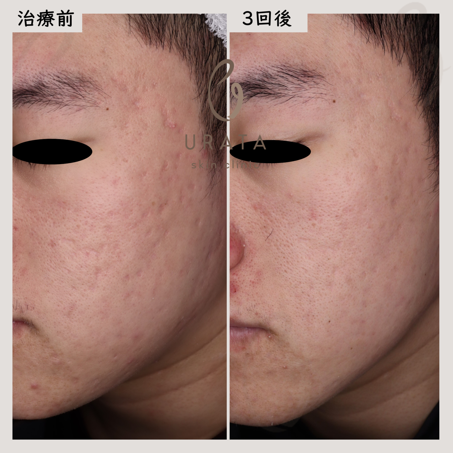 ニキビ跡のポテンツァ治療２