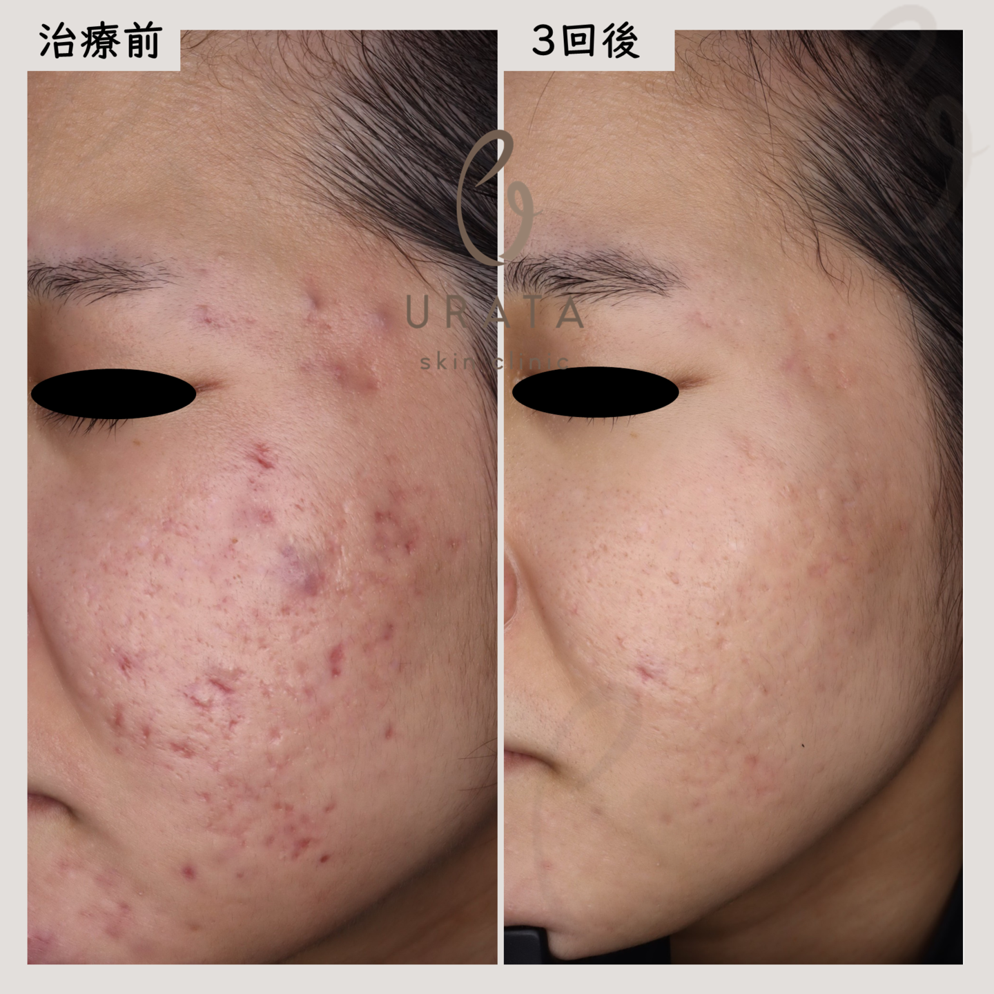 CO2フラクショナルによるニキビ跡治療１