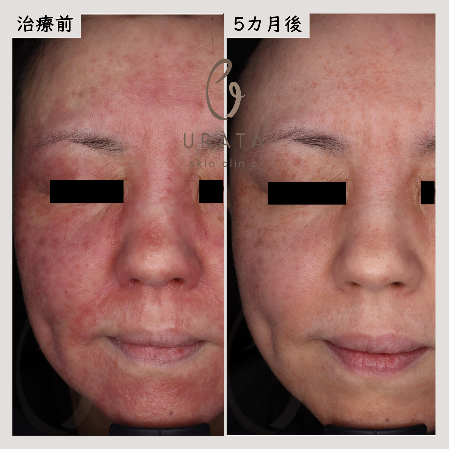 酒さのレーザー治療４