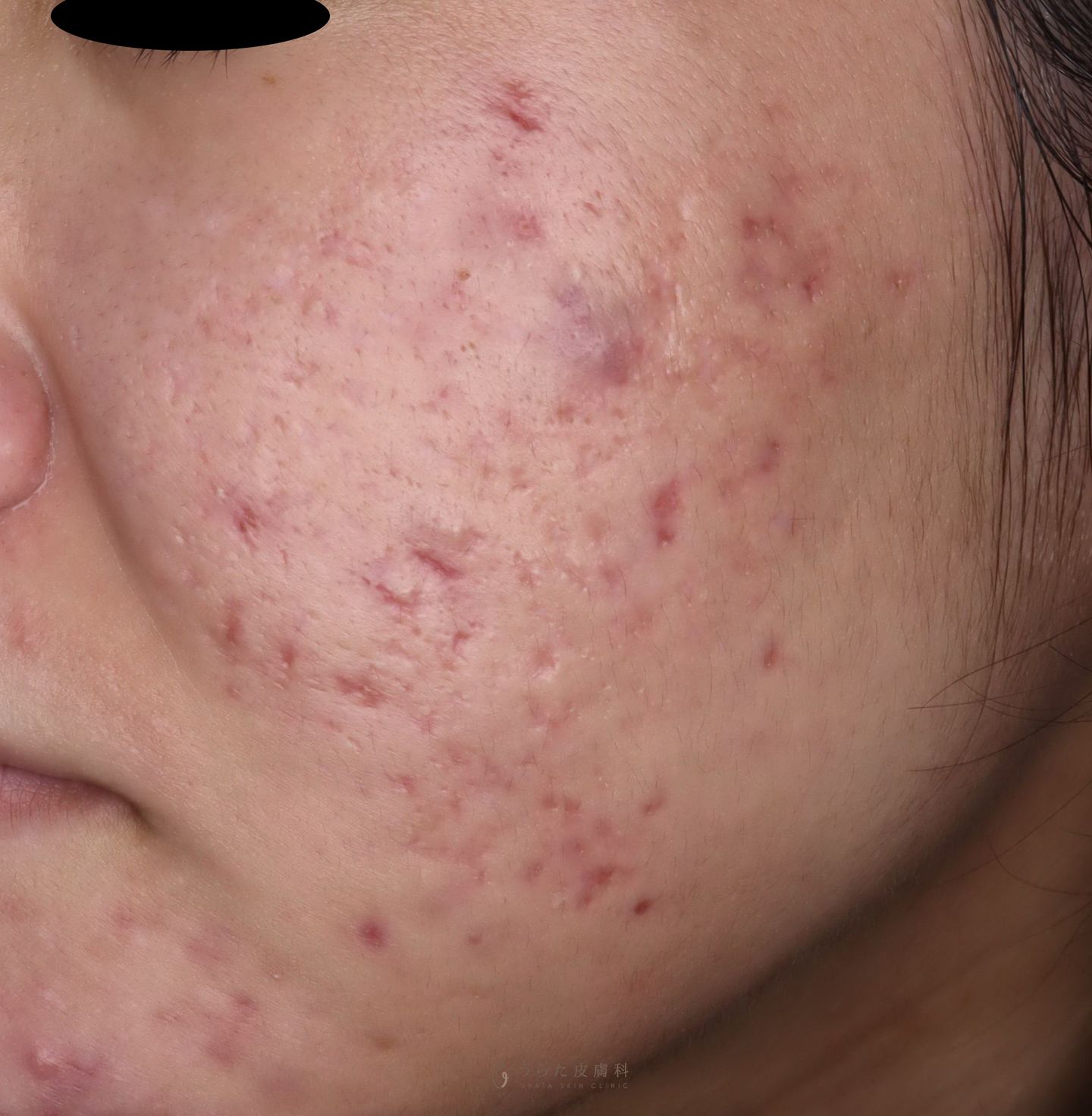 凹んだニキビ跡と赤いニキビ跡