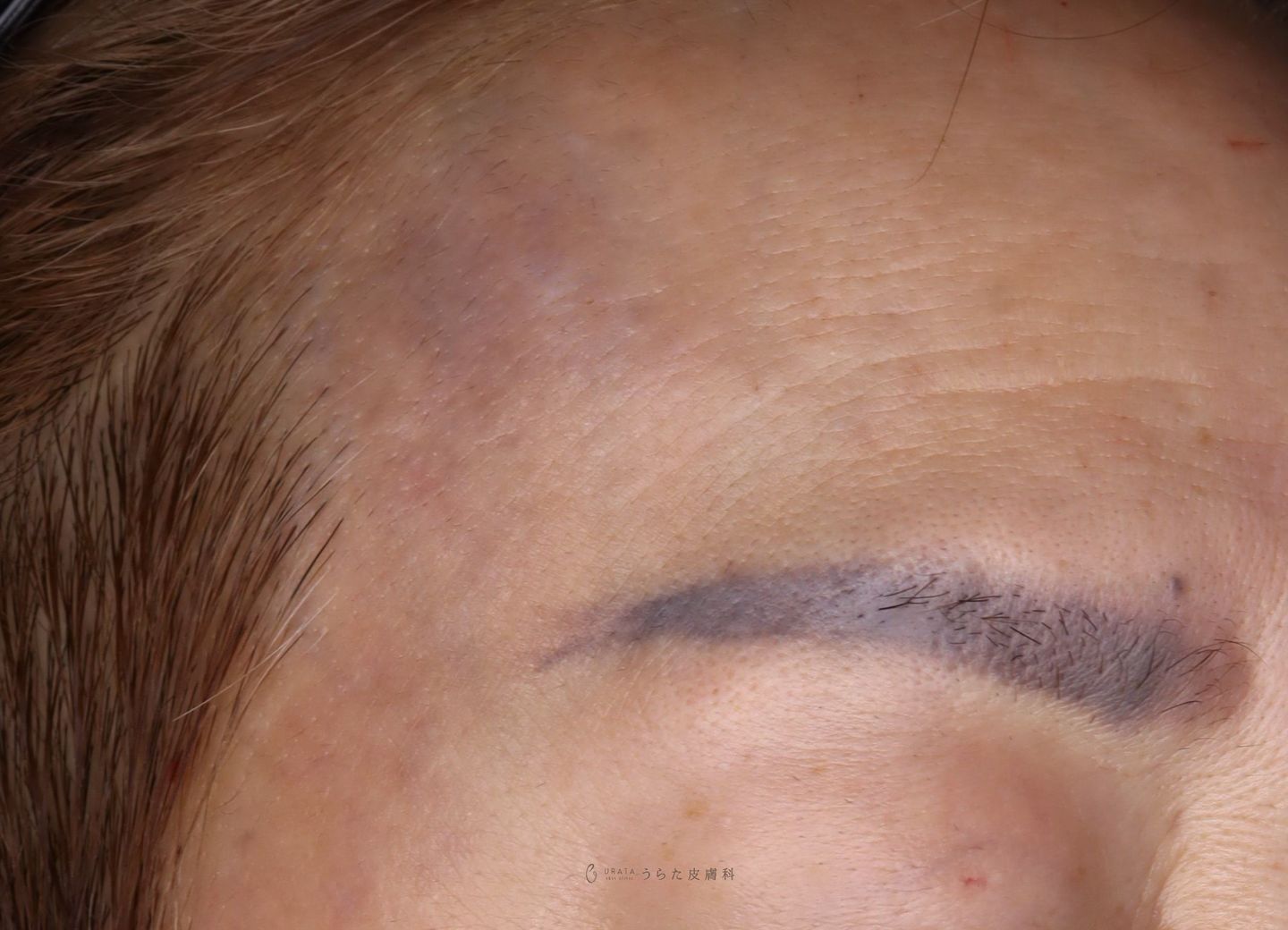 ADMのレーザー治療３回後