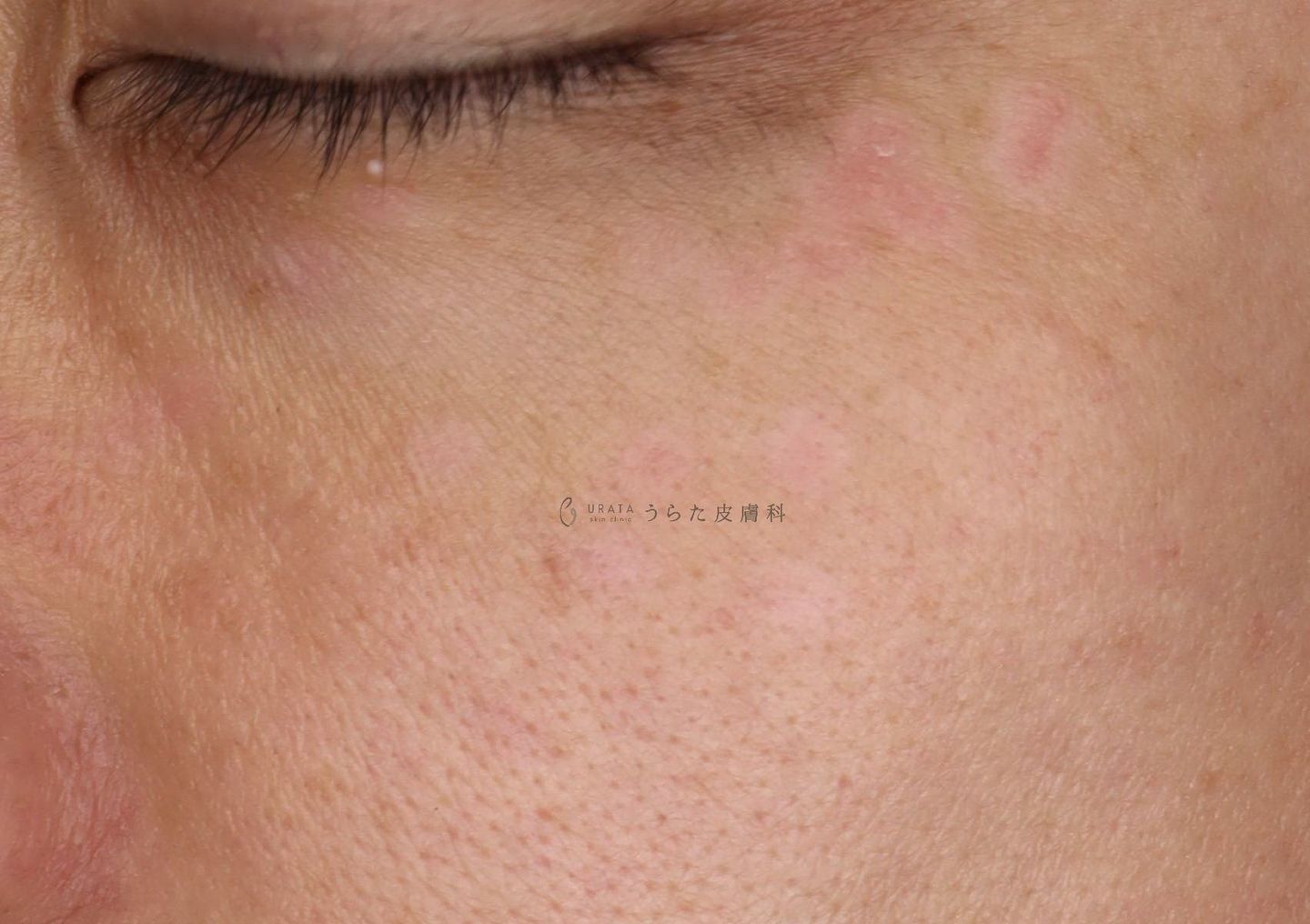 シミのスポット治療1週間後