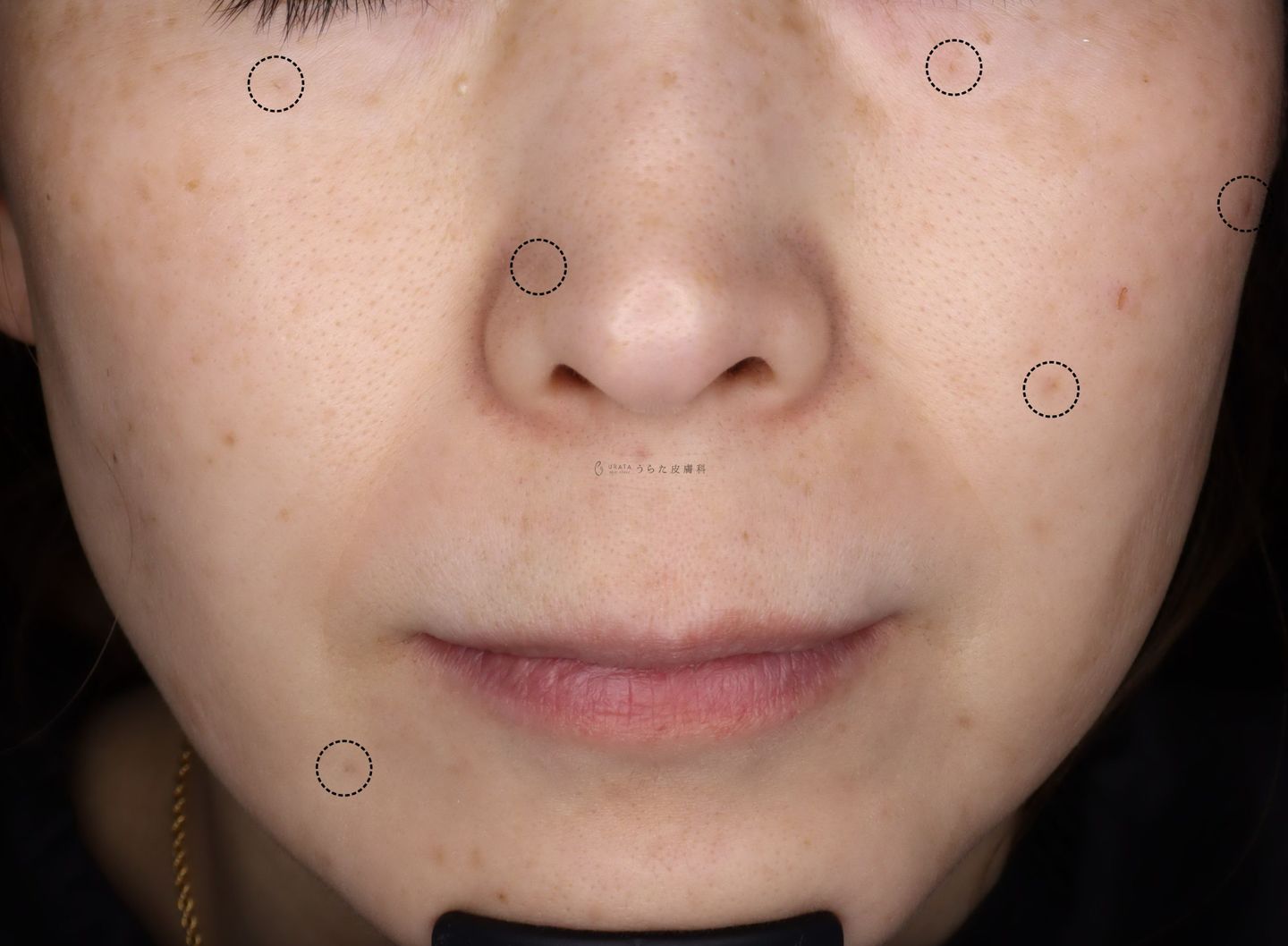 ホクロ手術4カ月後