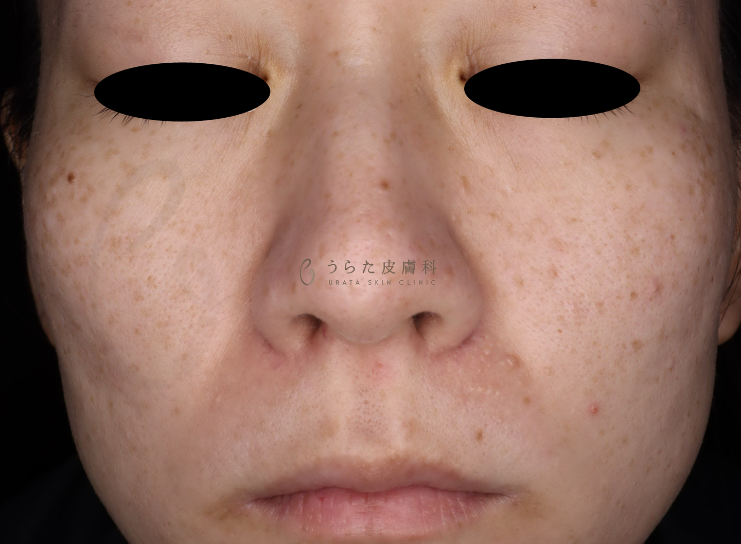 ピコトリプル治療前