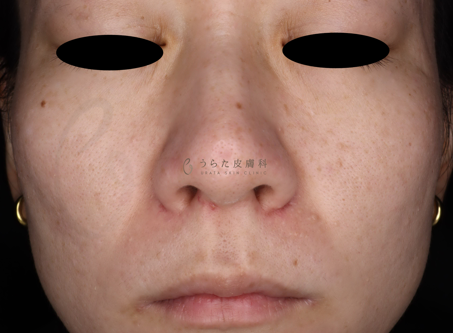 ピコトリプル1回後