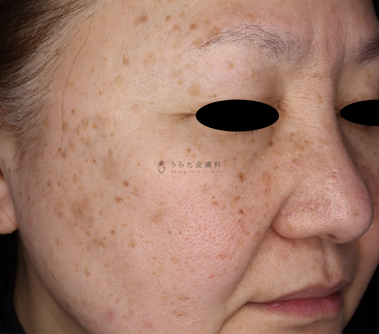 ピコトリプル治療前