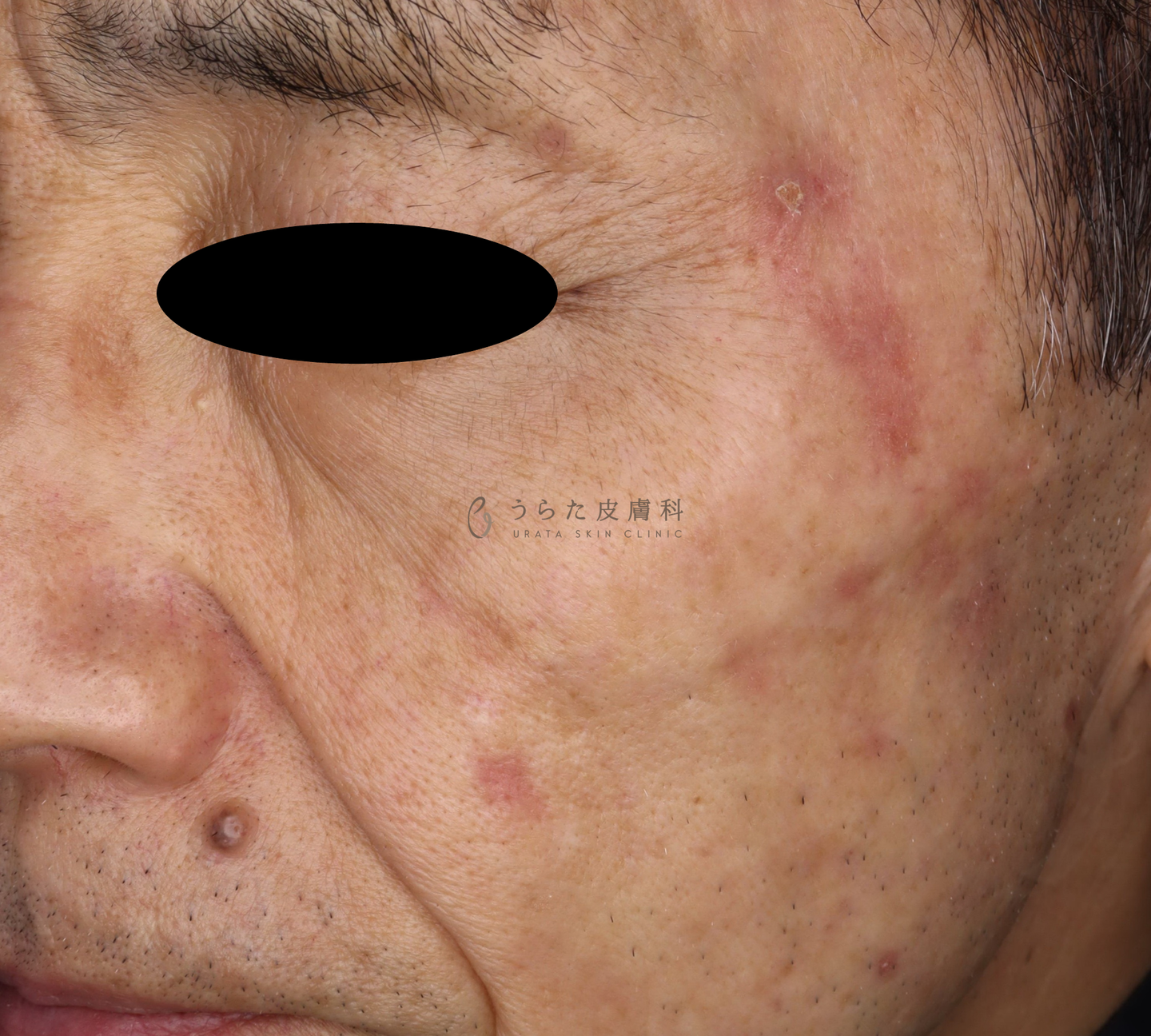 ピコスポット2週間後