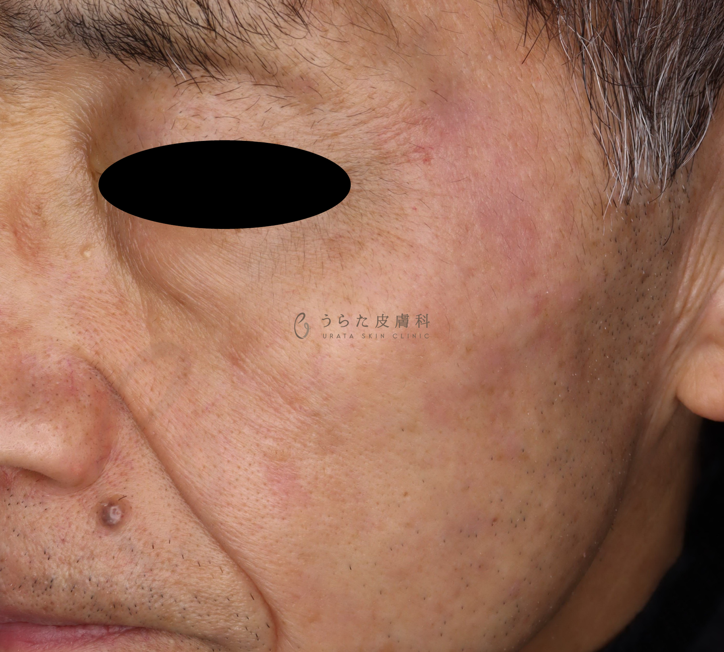 ピコスポットの色素沈着2カ月後