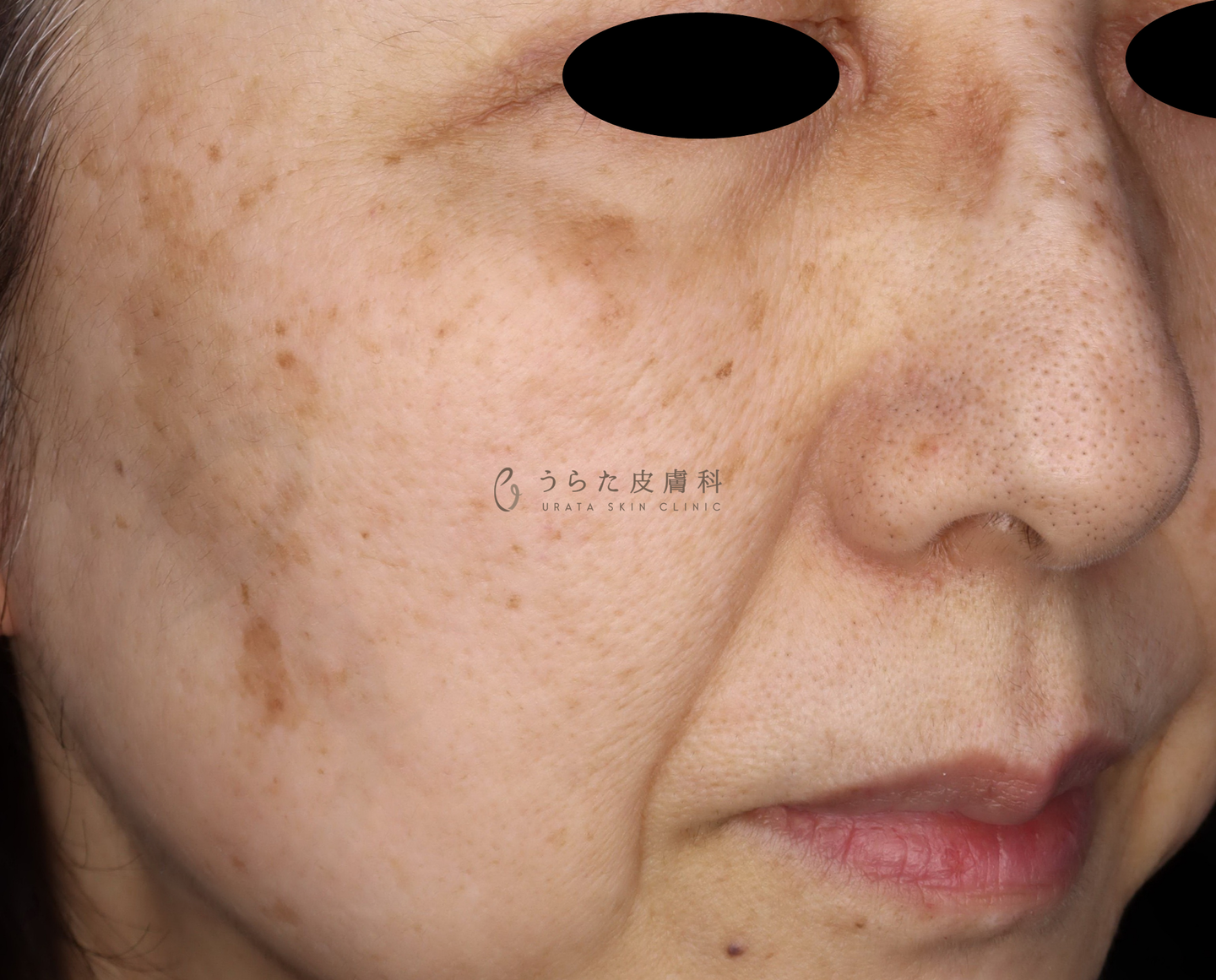 ピコスポット治療前