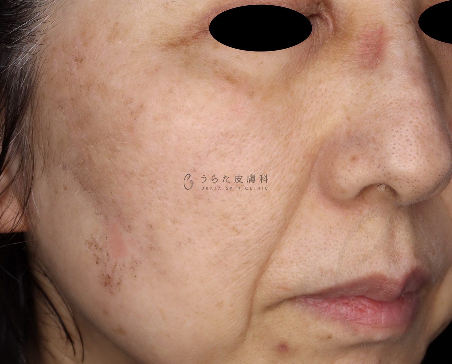 ピコスポット1週間後