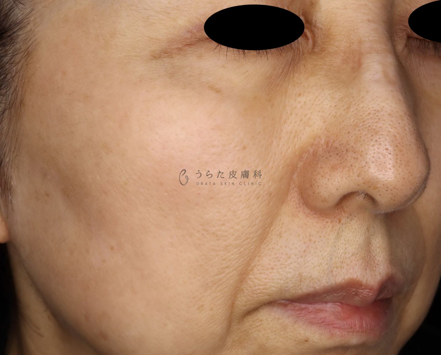 ピコスポット治療後の色素沈着の治療後