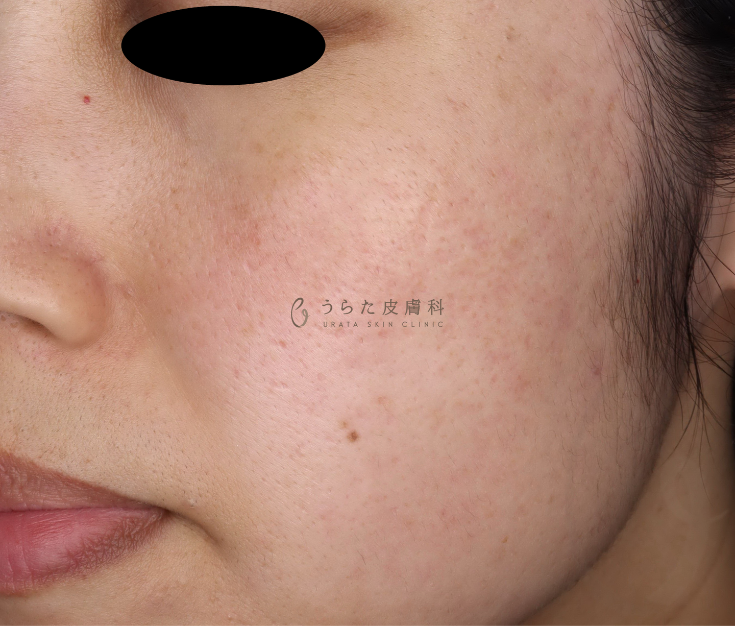 ニキビのポテンツァ7回後