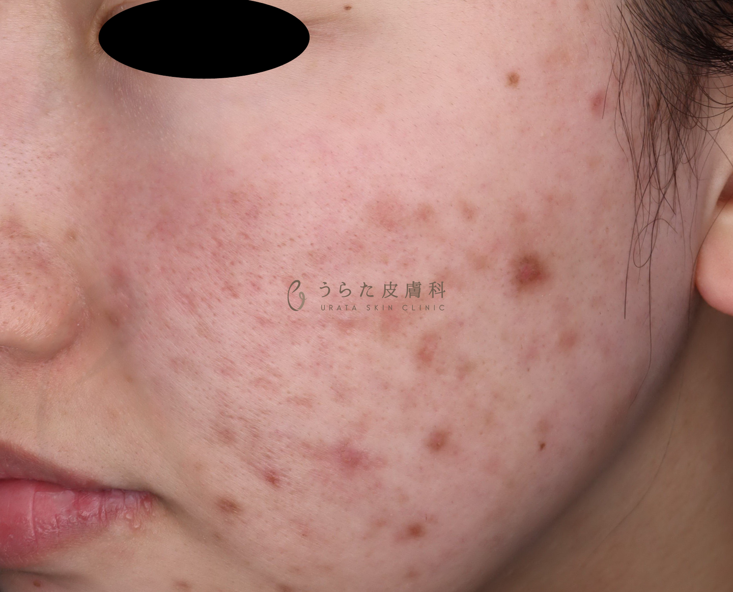 ニキビのポテンツァ2回後