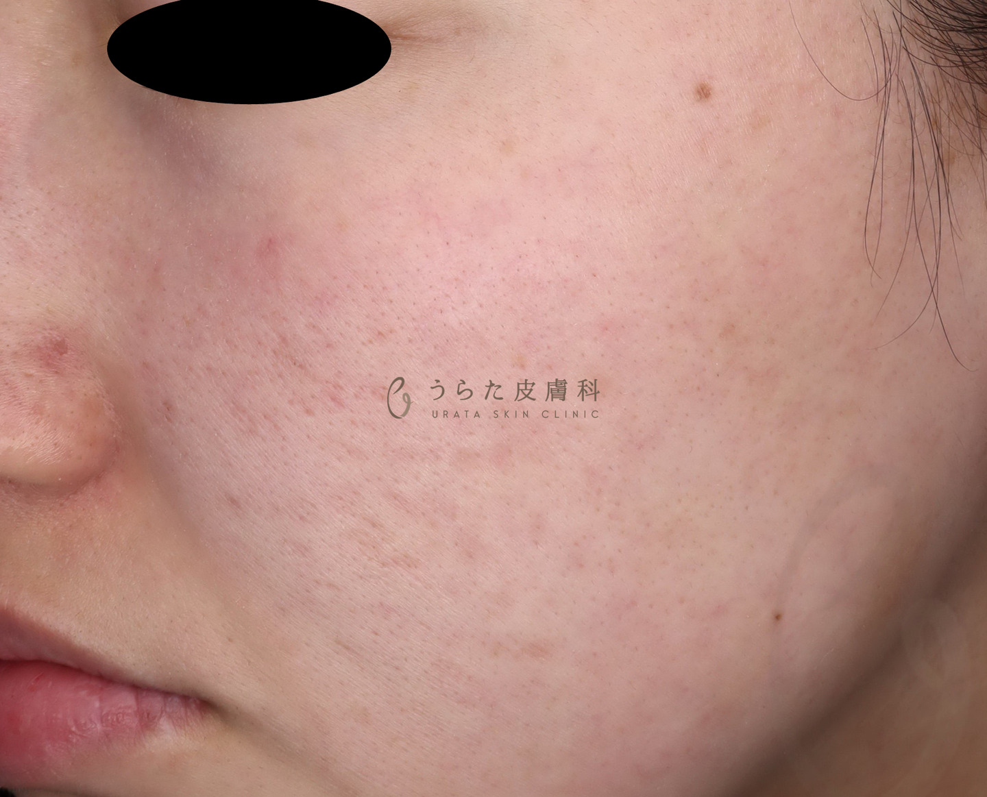 ニキビのポテンツァ6回後