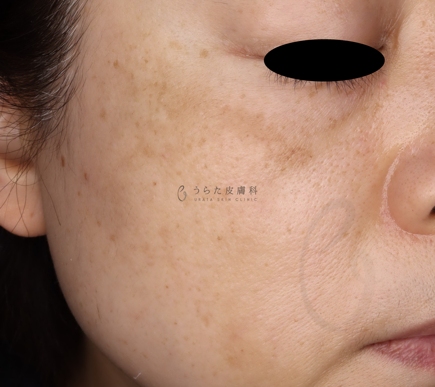 肝斑のゼオスキン治療前