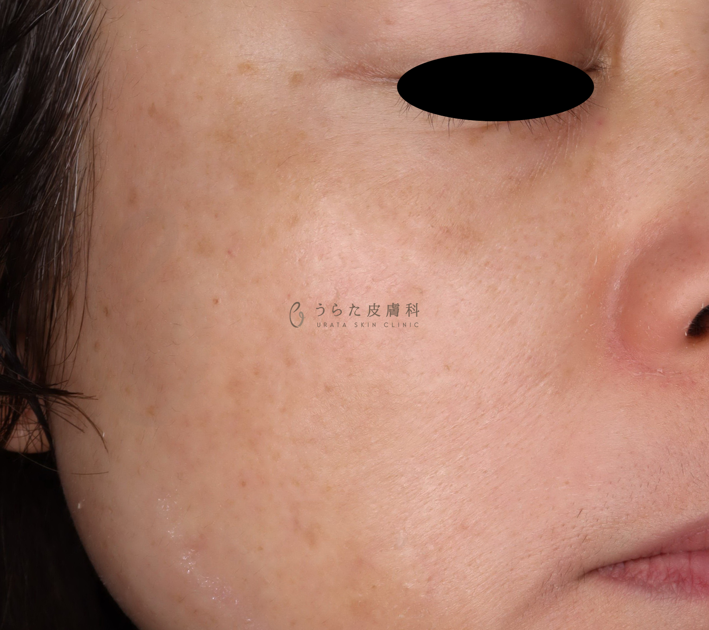 肝斑のゼオスキン治療2週間後