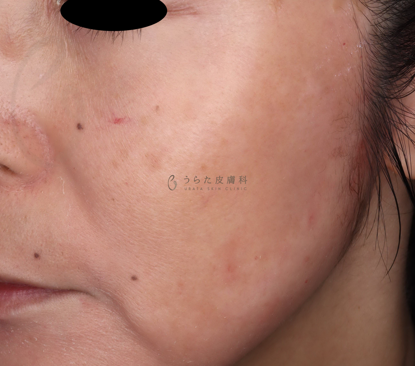 肝斑のトレチノイン治療６週間後