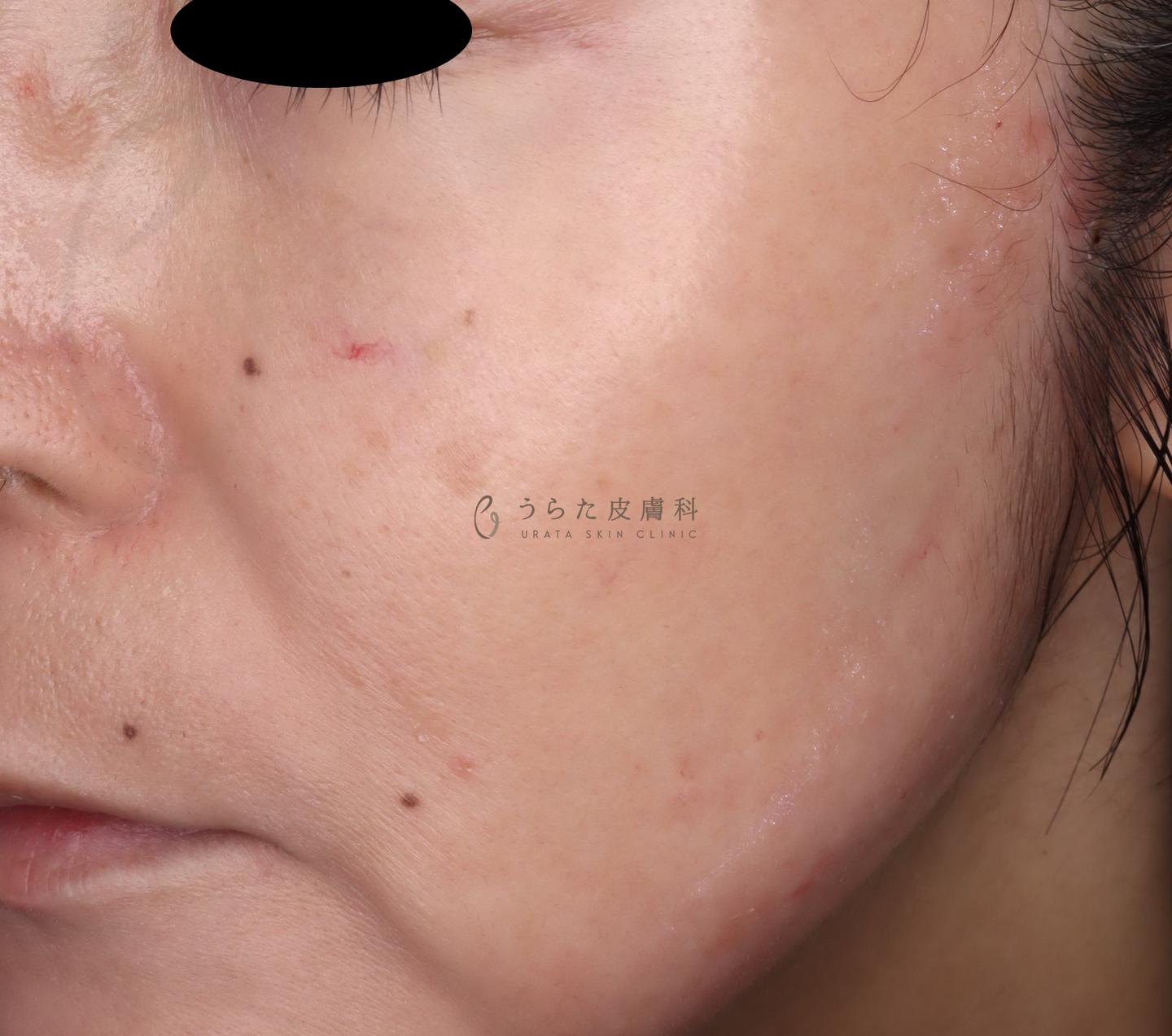 肝斑のトレチノイン治療4週間後、トナー併用4週間後