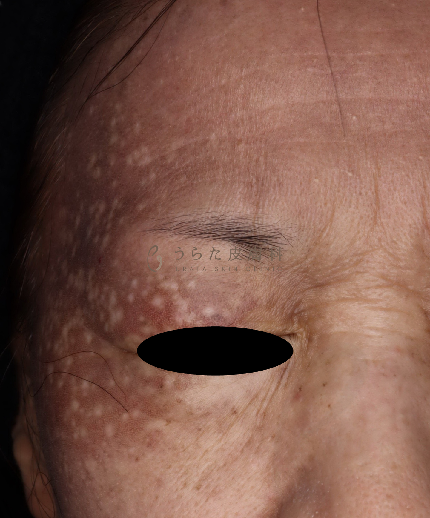 炎症後色素沈着のトレチノイン治療前