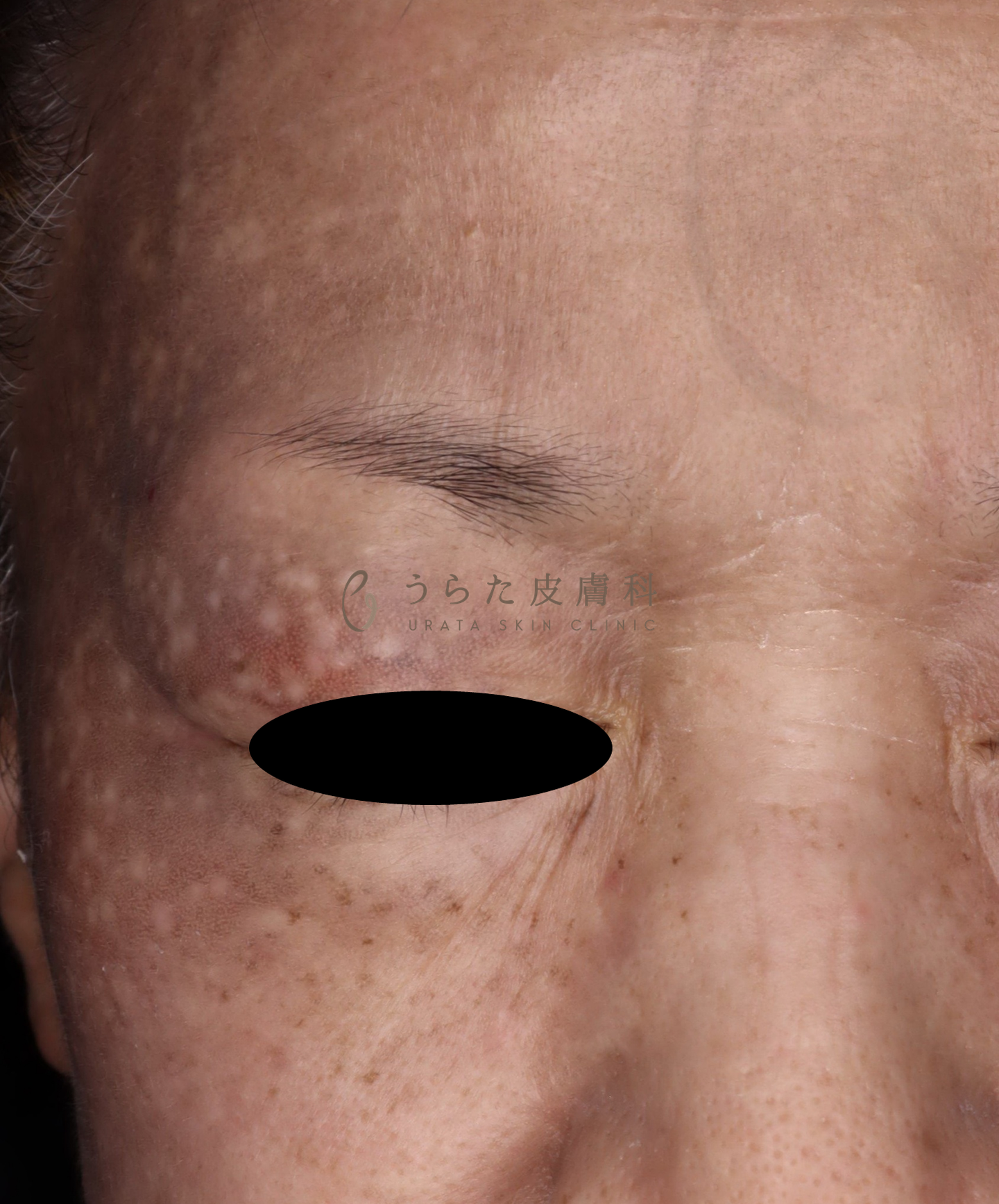 炎症後色素沈着のトレチノイン治療3カ月後