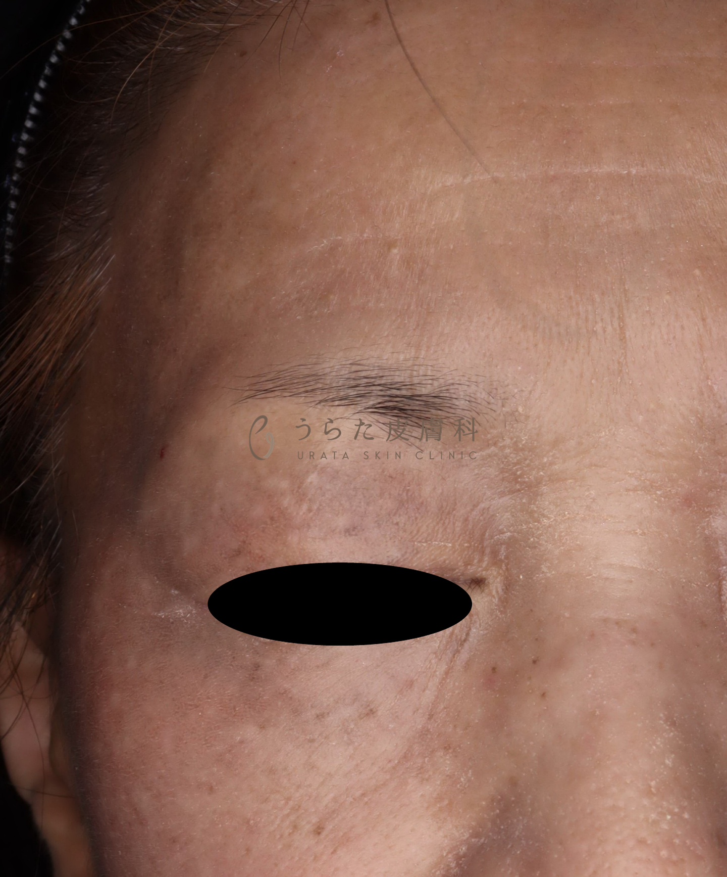 炎症後色素沈着のトレチノイン治療5カ月後