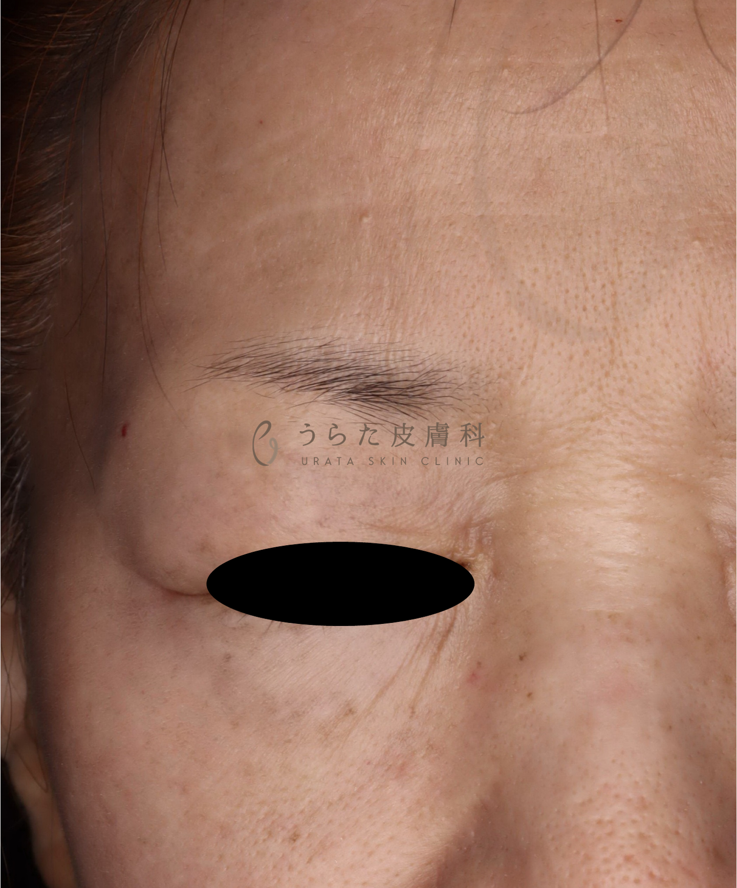 炎症後色素沈着の治療後