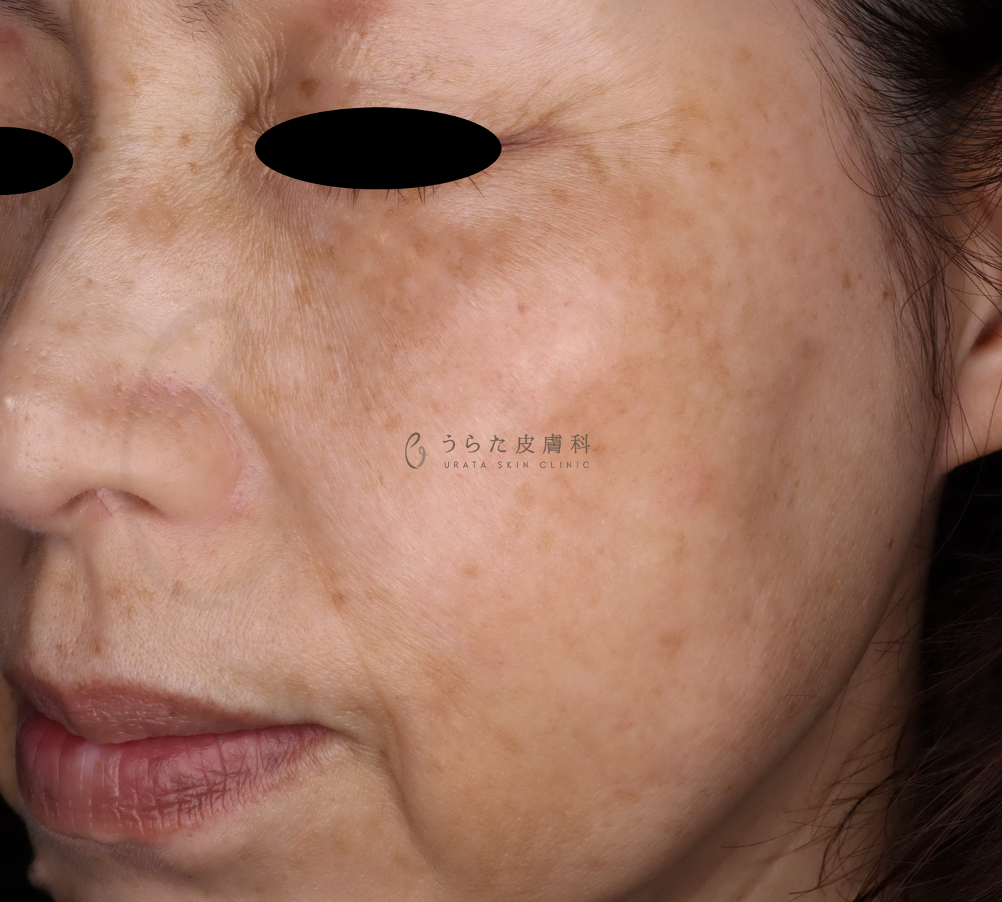 ピコレーザー治療2回後