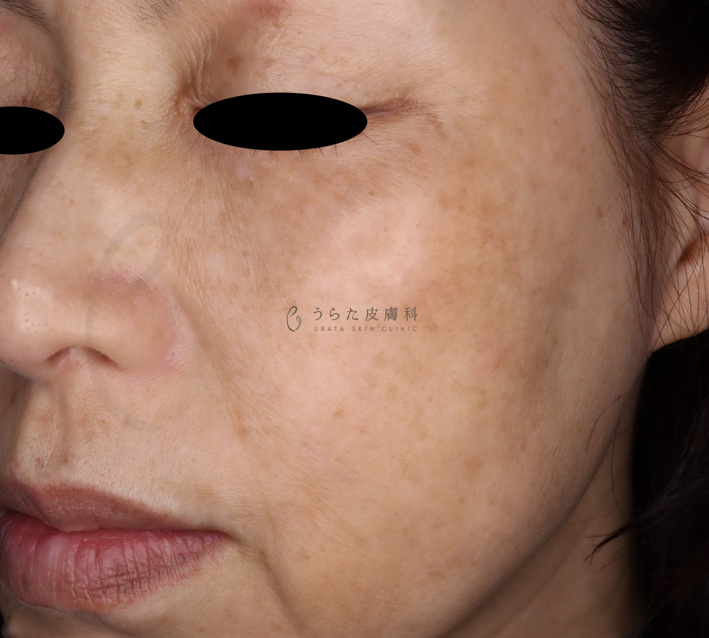 ピコレーザー治療4回後