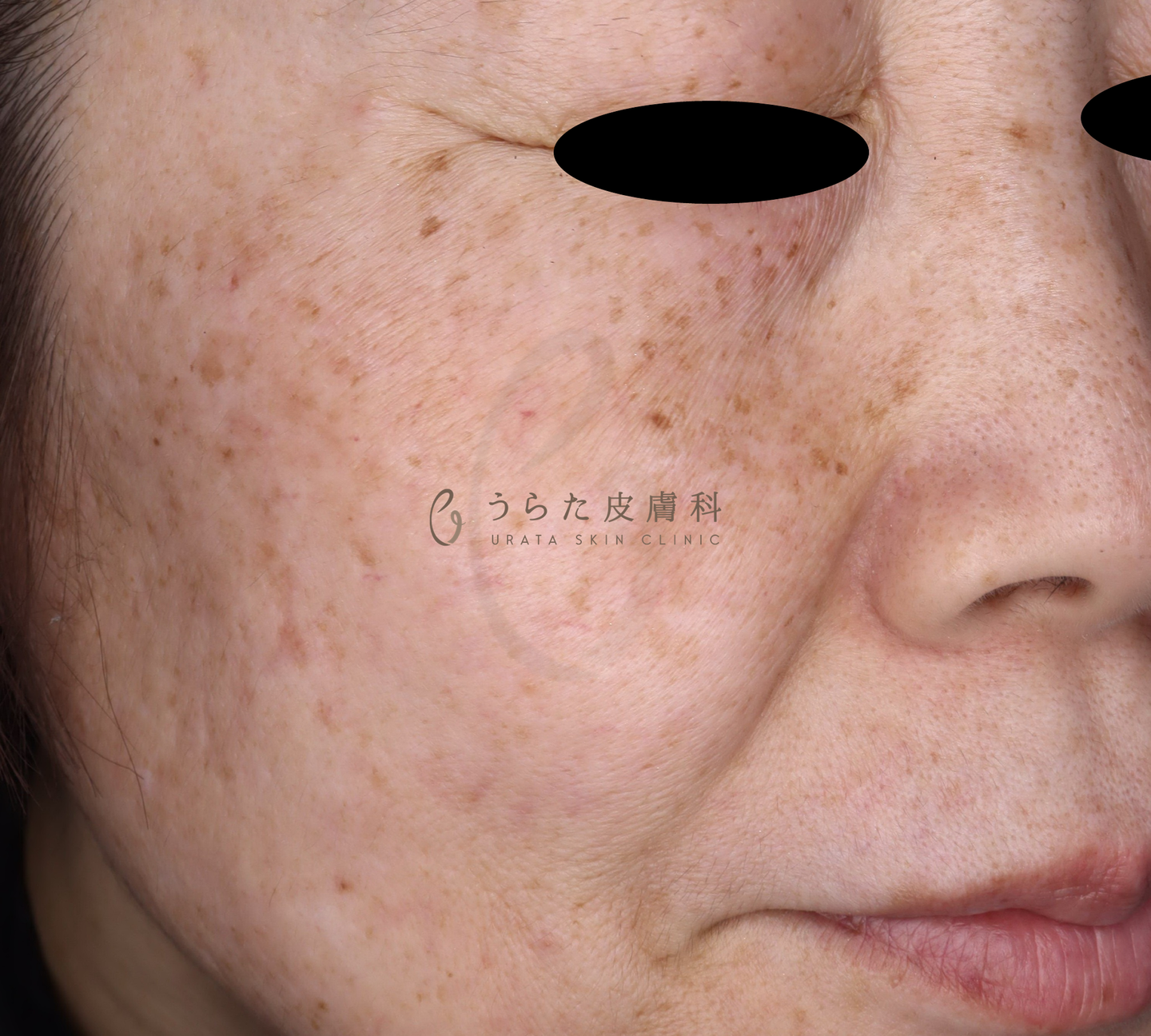 ルメッカ治療前