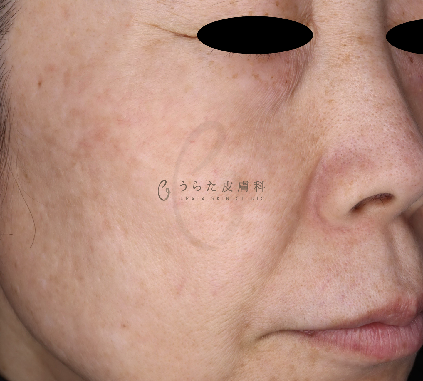 老人性色素斑のルメッカ4回後