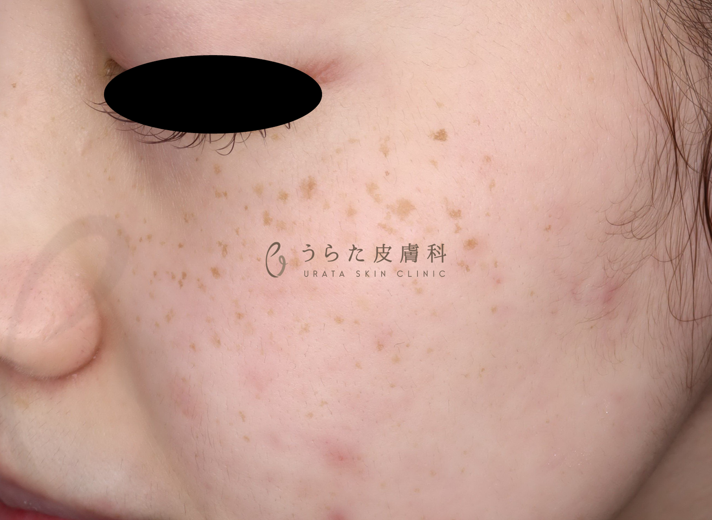そばかすのルメッカ治療前
