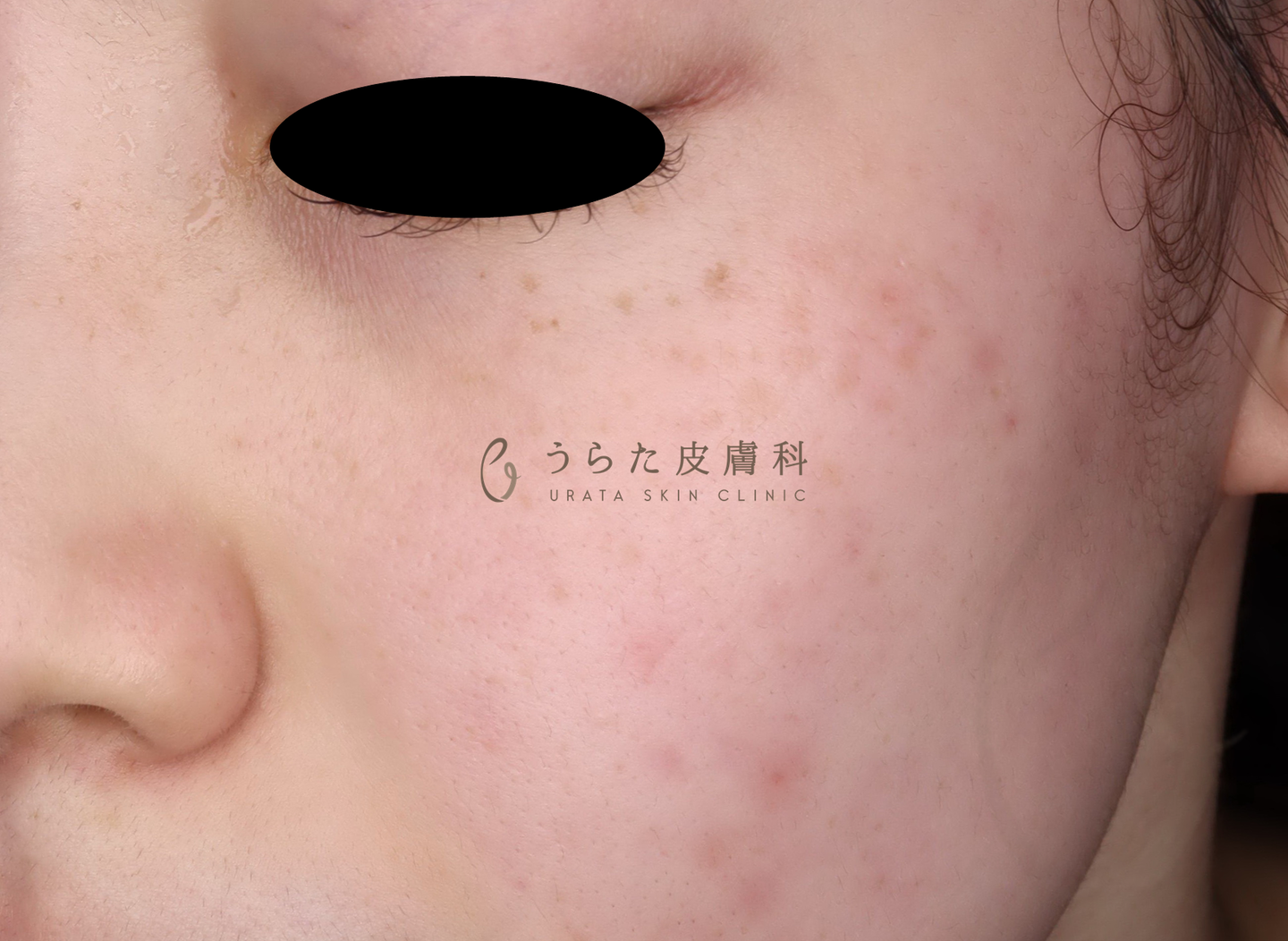 そばかすのルメッカ治療1回後
