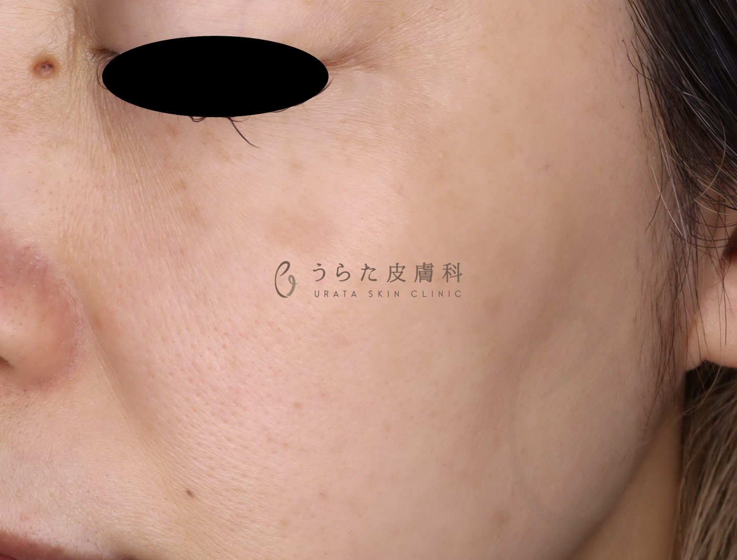 シミのルメッカ治療３回後