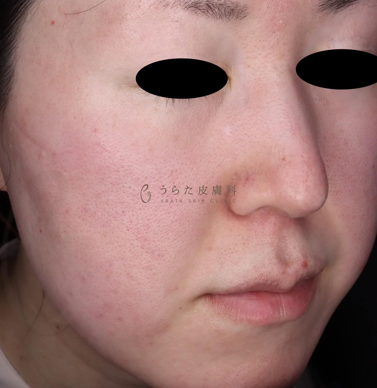 赤ら顔のルメッカ治療1回後