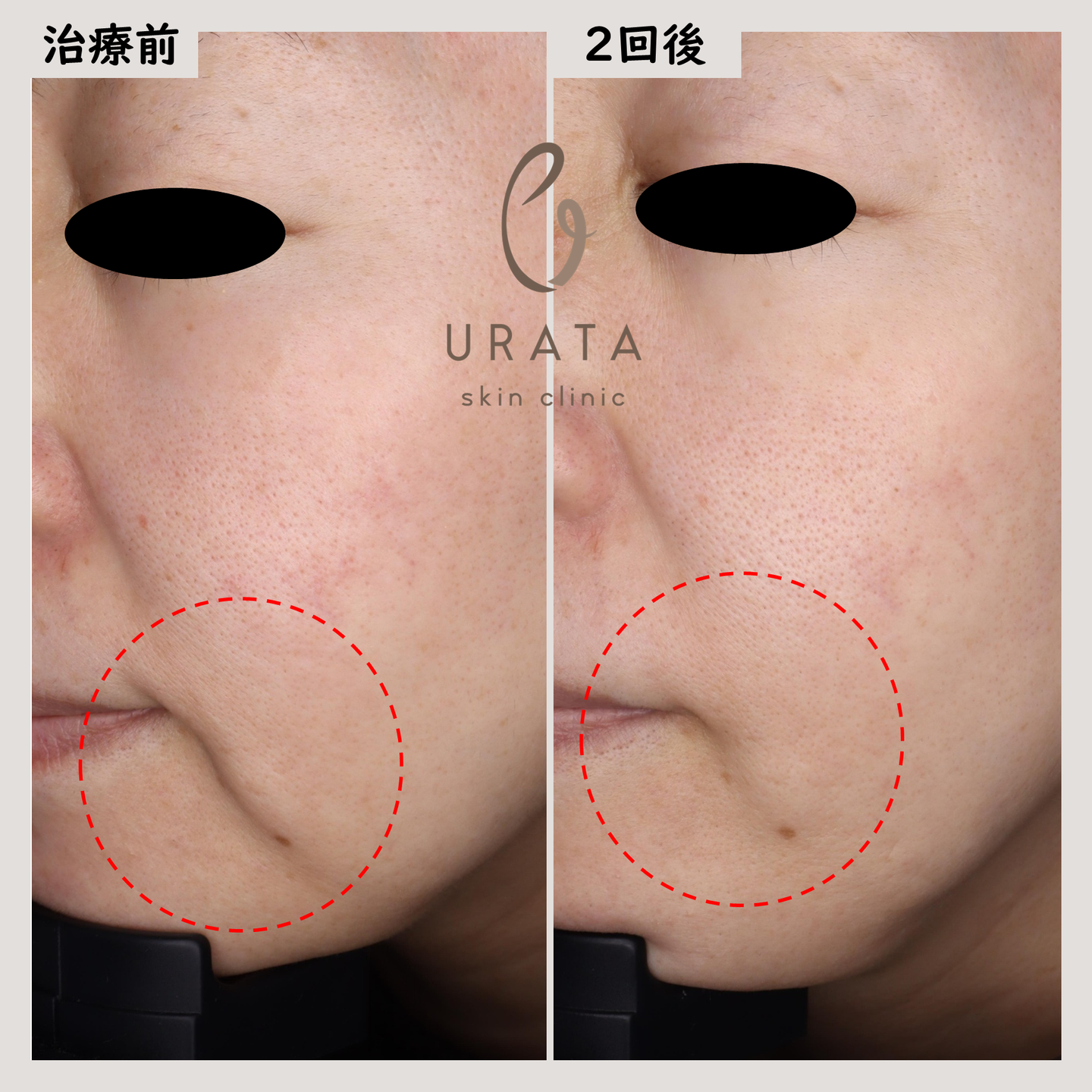 インモードリフトの症例写真１