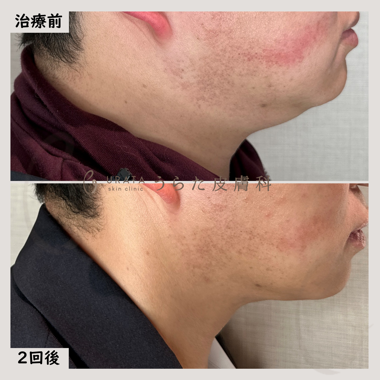 インモードリフトの症例写真２