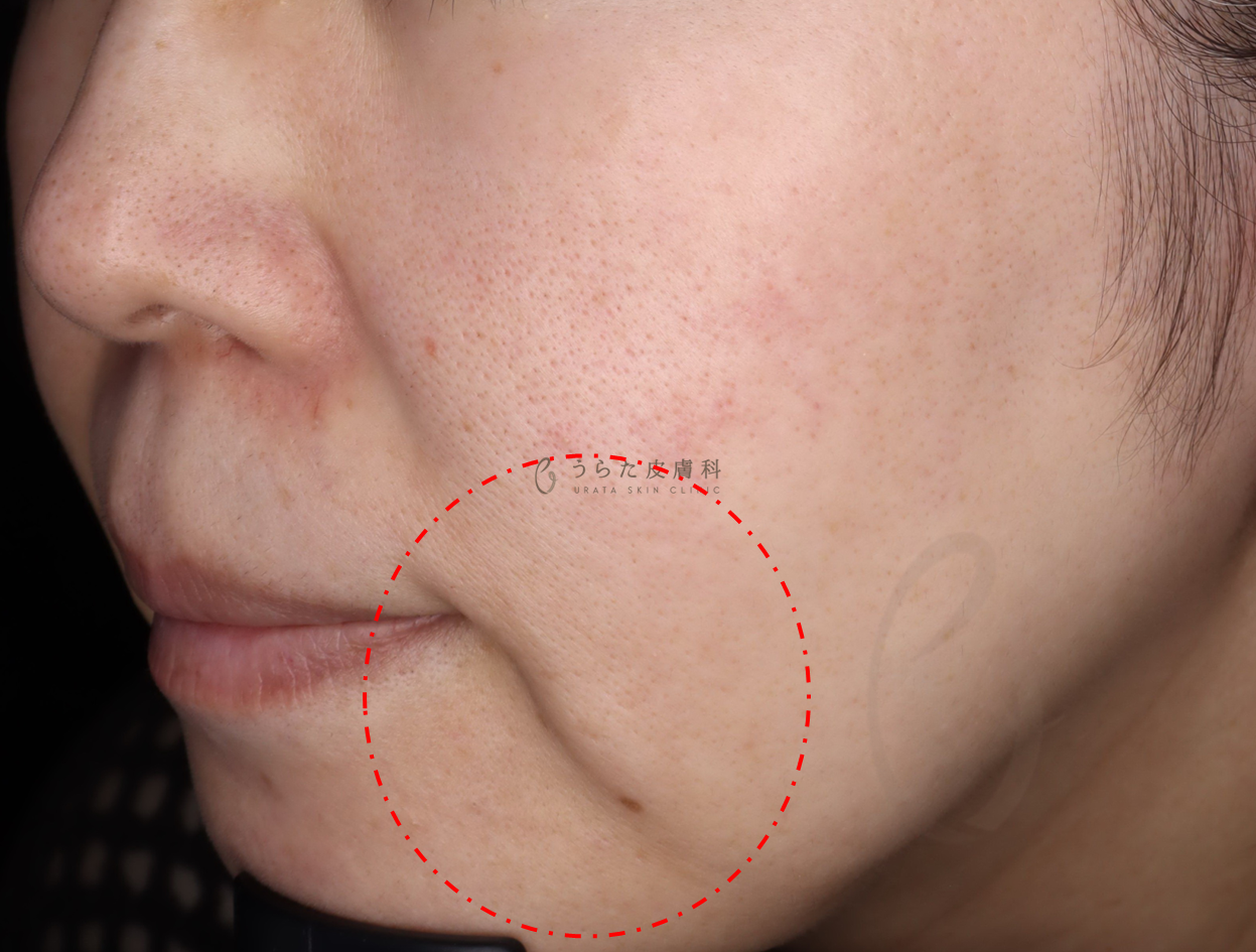 インモード治療前